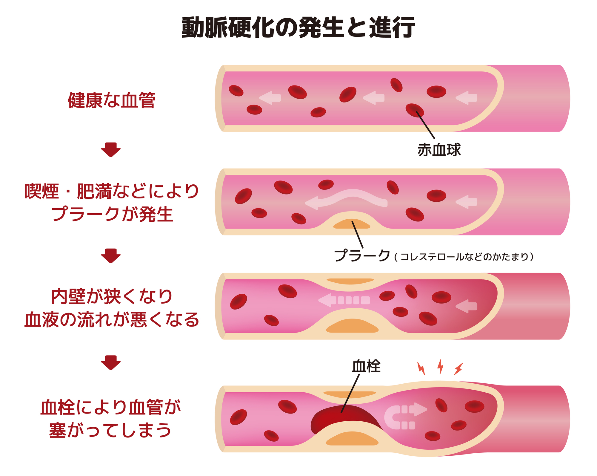 動脈硬化の発生と進行イメージ図